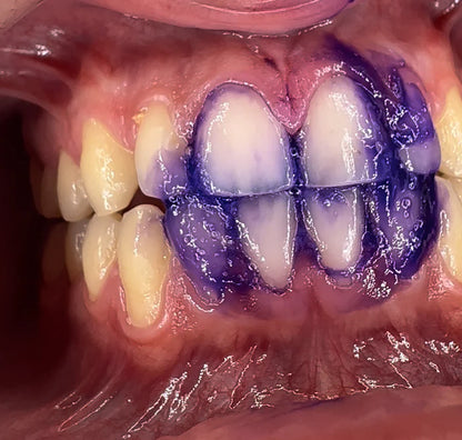 PureSmile - Blanqueador dental
