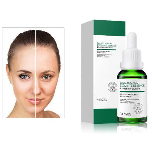 Kit Limpieza Profunda Anti-Acne de Acido Salicílico 5 en 1