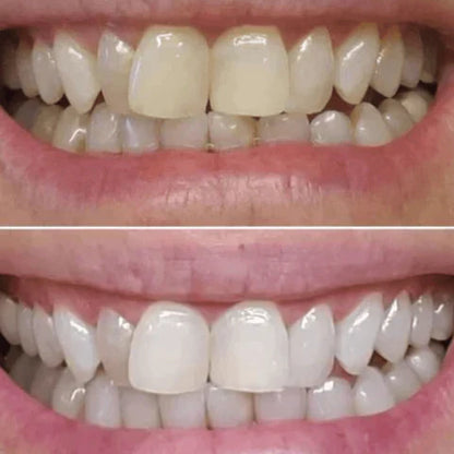 PureSmile - Blanqueador dental